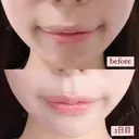 ヒアルロン酸注入（鼻） / ヒアルロン酸注入（あご） / ヒアルロン酸注入（唇） ヴェリテクリニック 大阪院 AFTER サムネイル用