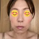 脂肪吸引（顔） / 脂肪吸引（お腹） / 豊胸（脂肪注入） / 脂肪注入（肌） / 乳頭縮小 / 脂肪吸引（腰） / ボトックス（エラ・小顔） Mods Clinic（モッズクリニック） 大阪院 AFTER サムネイル用