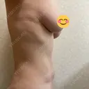 脂肪吸引（顔） / 脂肪吸引（お腹） / 豊胸（脂肪注入） / 脂肪注入（肌） / 乳頭縮小 / 脂肪吸引（腰） / ボトックス（エラ・小顔） Mods Clinic（モッズクリニック） 大阪院 DAY 188 サムネイル用