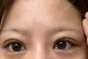 下まぶたの脂肪取り APOLLO BEAUTY CLINIC DAY 15 サムネイル用