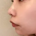 ヒアルロン酸注入（あご） / ヒアルロン酸注入（鼻翼基部） KAGA CLINIC AFTER サムネイル用