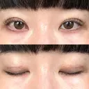 二重埋没 / ボトックス（エラ・小顔） / ボトックス（肩） THE FIRST CLINIC 多摩センター院 DAY 3 サムネイル用
