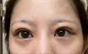 下まぶたの脂肪取り APOLLO BEAUTY CLINIC DAY 16 サムネイル用