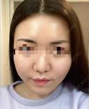 骨切り（あご） / 骨削り（エラ） / 骨削り（頬） セギム美容整形外科 AFTER サムネイル用