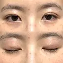 二重埋没 / その他（目元） 湘南美容クリニック 藤沢院 DAY 14 サムネイル用