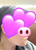 ボトックス（エラ・小顔） / ボトックス（口角） ビューティースキンクリニック 池袋院 DAY 8 サムネイル用