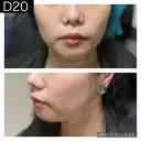 糸リフト PRISM Beauty Clinic 町田院 DAY 20 サムネイル用