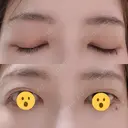 二重埋没 / 上まぶたの脂肪取り THE FIRST CLINIC 多摩センター院 DAY 6 サムネイル用