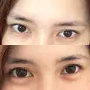 ヒアルロン酸注入（涙袋） ファイヤークリニック 渋谷院 AFTER サムネイル用