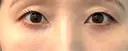 クマ治療 / 脂肪注入（目の下） 湘南美容クリニック 千葉センシティ院 AFTER サムネイル用