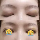 二重埋没 / 上まぶたの脂肪取り THE FIRST CLINIC 多摩センター院 DAY 7 サムネイル用
