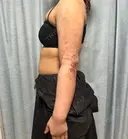 脂肪吸引（二の腕） / 脂肪吸引（背中） / 脂肪吸引（肩） 湘南美容クリニック 京都院 DAY 4 サムネイル用