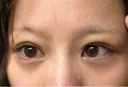 下まぶたの脂肪取り APOLLO BEAUTY CLINIC DAY 19 サムネイル用