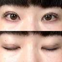 二重埋没 / ボトックス（エラ・小顔） / ボトックス（肩） THE FIRST CLINIC 多摩センター院 DAY 6 サムネイル用