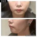 糸リフト PRISM Beauty Clinic 町田院 DAY 22 サムネイル用