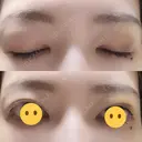 二重埋没 / 上まぶたの脂肪取り THE FIRST CLINIC 多摩センター院 DAY 8 サムネイル用
