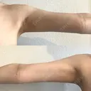 脂肪吸引（二の腕） / その他（胸） / 脂肪吸引（肩） 湘南美容クリニック 渋谷院 AFTER サムネイル用