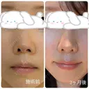 隆鼻術 / 鼻尖形成（切開） / 小鼻縮小（切開） / 軟骨移植 / 鼻柱下降・鼻唇角形成（猫手術） / ボトックス（エラ・小顔） / 毛穴洗浄（ハイドラフェイシャルなど） グローバルビューティークリニック 大阪院 DAY 90 サムネイル用