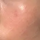 その他（肌） YAYOI CLINIC DAY 2 サムネイル用