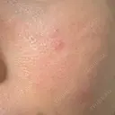 その他（肌） YAYOI CLINIC DAY 3 サムネイル用