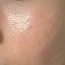 その他（肌） YAYOI CLINIC DAY 5 サムネイル用