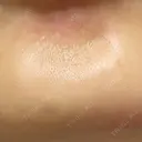 ボトックス（あご） / ボトックス（口角） DMTC CLINIC 日本橋院 DAY 6 サムネイル用