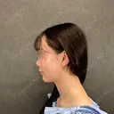 糸リフト / 脂肪吸引（顔） ネビュラクリニック 京都院 DAY 0 サムネイル用