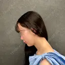 糸リフト / 脂肪吸引（顔） ネビュラクリニック 京都院 DAY 0 サムネイル用