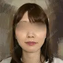 糸リフト / 脂肪吸引（顔） / ジョールファット除去 / 脂肪吸引注射（顔） / ヒアルロン酸注入（あご） SEA CLINIC（シークリニック） DAY 63 サムネイル用