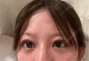 下まぶたの脂肪取り APOLLO BEAUTY CLINIC AFTER サムネイル用