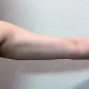 ワキ汗治療（レーザー） Fellez Clinic【フェルズクリニック】 DAY 31 サムネイル用