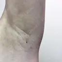 ワキ汗治療（レーザー） Fellez Clinic【フェルズクリニック】 DAY 31 サムネイル用