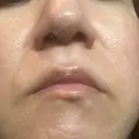 エレクトロポレーション / フラクショナルレーザー（毛穴・ニキビ跡） 心斎橋KT美容クリニック DAY 2 サムネイル用