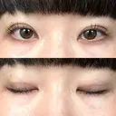 二重埋没 / ボトックス（エラ・小顔） / ボトックス（肩） THE FIRST CLINIC 多摩センター院 AFTER サムネイル用