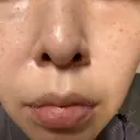 エレクトロポレーション / 光治療（フォトフェイシャルなど） / ルメッカ ゆきスキンクリニック 東池袋 DAY 1 サムネイル用