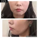 糸リフト PRISM Beauty Clinic 町田院 DAY 23 サムネイル用