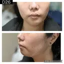 糸リフト PRISM Beauty Clinic 町田院 DAY 26 サムネイル用