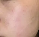 ピコレーザートーニング（美白・かんぱん） / ピコフラクショナルレーザー（毛穴・ニキビ跡） おおかみ美容のクリニック 新宿院 DAY 2 サムネイル用