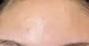 ピコレーザートーニング（美白・かんぱん） / ピコフラクショナルレーザー（毛穴・ニキビ跡） おおかみ美容のクリニック 新宿院 DAY 2 サムネイル用
