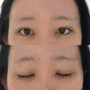 目頭切開 / クマ治療 / 目尻切開 / 下まぶたの脂肪取り / タレ目形成・グラマラスライン（切開） / タレ目形成・グラマラスライン（埋没） / ヒアルロン酸注入（涙袋） / ボトックス（エラ・小顔） Tokyo Tensei Clinic 銀座院 DAY 22 サムネイル用