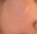 ピコレーザートーニング（美白・かんぱん） / ピコフラクショナルレーザー（毛穴・ニキビ跡） おおかみ美容のクリニック 新宿院 DAY 4 サムネイル用