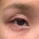 その他（目元） グリシーヌクリニック DAY 0 サムネイル用