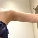 脂肪吸引（二の腕） Mods Clinic（モッズクリニック） 名古屋院 DAY 186 サムネイル用
