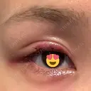 その他（目元） グリシーヌクリニック DAY 2 サムネイル用