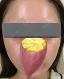 その他（肌） / ピーリング（ハリ・ツヤ） 東京シンデレラ美容外科 大宮院 DAY 0 サムネイル用