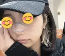 鼻尖形成（切開） / 鼻中隔延長（切開） / 軟骨移植 / ワシ鼻修正・ハンプ切除 / 鼻修正 R Beauty CLINIC 銀座院 DAY 4 サムネイル用