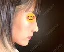 鼻尖形成（切開） / 鼻中隔延長（切開） / 軟骨移植 / ワシ鼻修正・ハンプ切除 / 鼻修正 R Beauty CLINIC 銀座院 DAY 232 サムネイル用