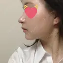 鼻尖形成（切開） / 鼻中隔延長（切開） / 小鼻縮小（切開） / 軟骨移植 / 鼻尖縮小 HANABI整形外科 DAY 20 サムネイル用