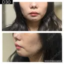 糸リフト PRISM Beauty Clinic 町田院 DAY 30 サムネイル用