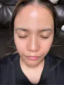 水光注射（ハリ・美肌） 小木曽クリニック AFTER サムネイル用